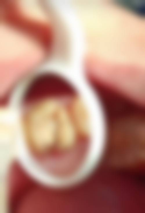 根尖周炎是不是牙神经已经死了的治疗实例