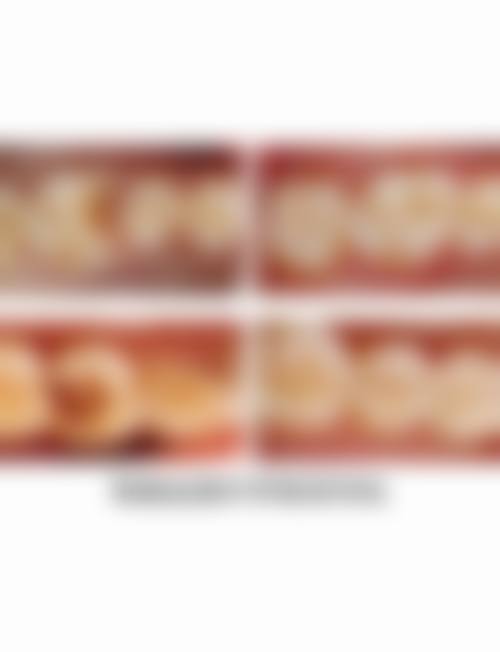 南宁同步口腔何建华做成人树脂Z350补牙技术优势：可靠的技术保护