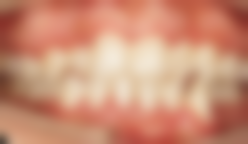 18岁矫正地包天选择惠州精英惠口腔江北院区适合吗？