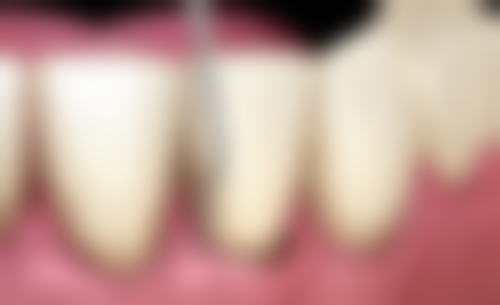 洗牙后避免用力漱口靠谱吗？