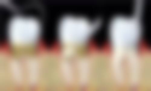 全瓷牙2m2和2m1在强度方面相差大吗？