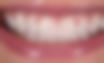 沈阳杏林整形外科医院口腔科拔牙之后喝水怎么喝不会感染？