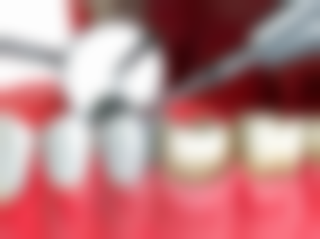 定期洗牙对牙齿美白有帮助吗?