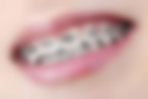 不同材料补牙后多久能正常吃东西，惠州精英惠口腔江北院区怎么样