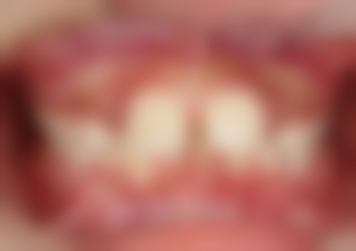 北京贝齿佳口腔门诊部种植牙和传统牙哪个更适合你？