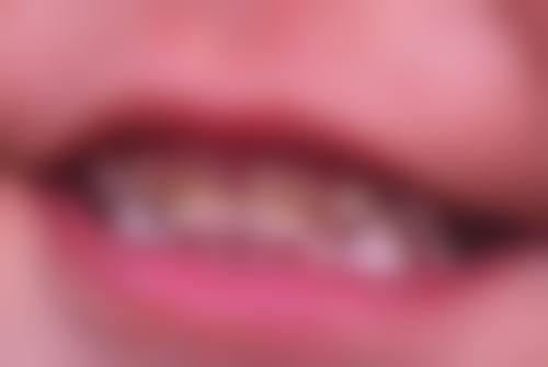 根管治疗做一次多久会影响修复成效吗？