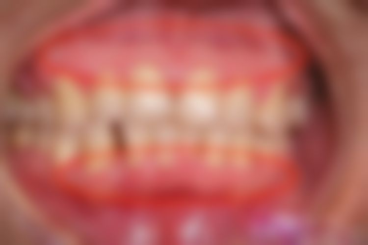 中度地包天不手术治疗靠谱吗?