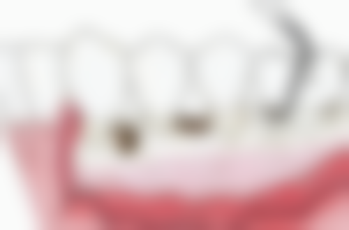 微创拔牙的优势怎么样