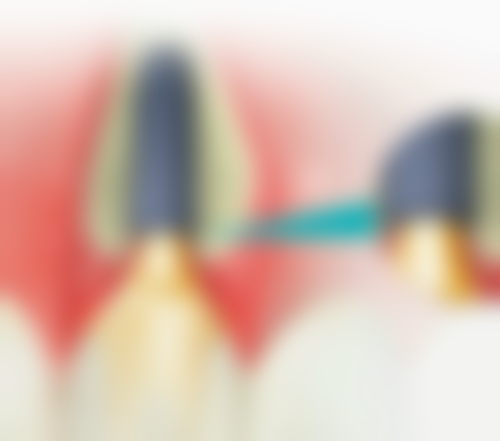 汉中内漂白法牙齿美白适合哪些人？