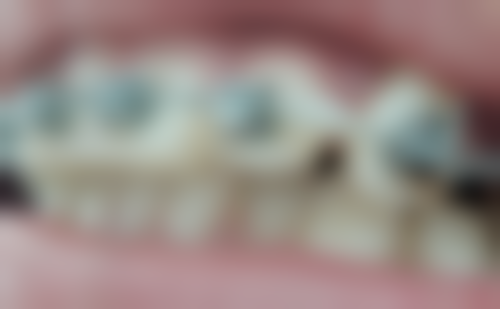 西安画美医疗美容医院根管治疗后牙齿疼处理靠谱吗