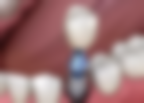 北京禾美嘉医疗美容医院适合经期补牙吗?