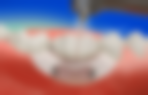 复杂阻生齿拔牙上午在北京画美医疗美容医院怎么样？