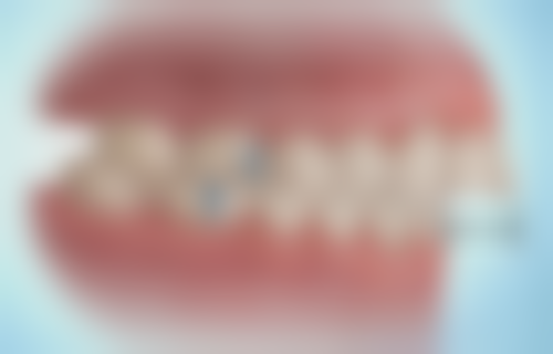 北京嘉禾医疗美容地包天矫正器佩戴时长值不值？