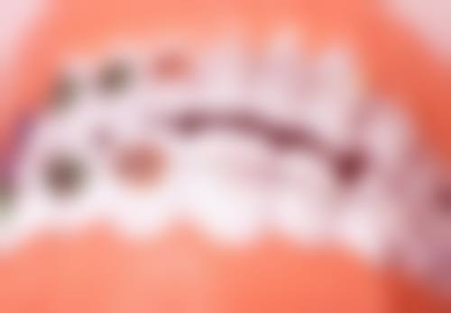 12岁男孩牙齿地包天现在纠正的方法有哪些？