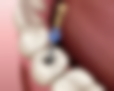 北京加减美医疗美容的牙冠安装靠谱吗