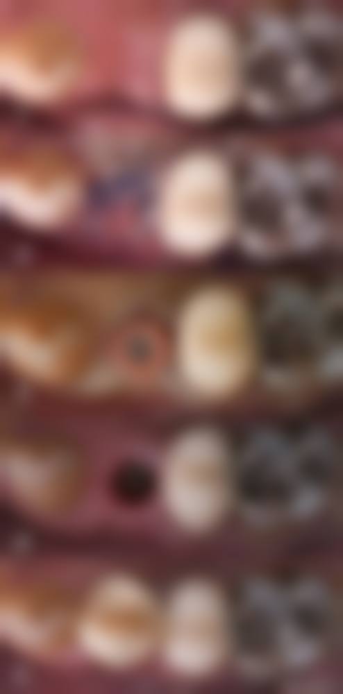 山东淄博博凡口腔真实实例：见证神奇蜕变