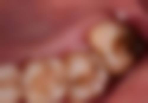 温州瑞安佳洁口腔门诊部洗牙大约需要多长时间值不值？