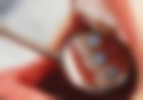 厦门思迈尔口腔补牙值不值？