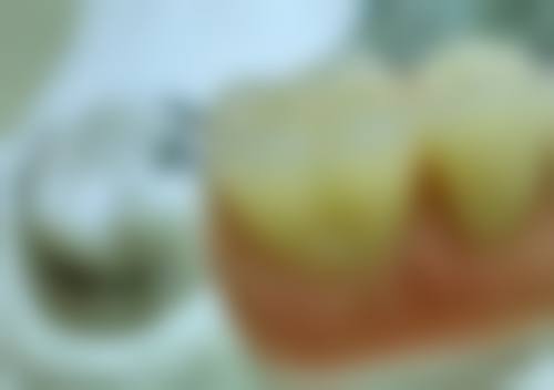 如何避免补牙材料因咬合压力过大脱落