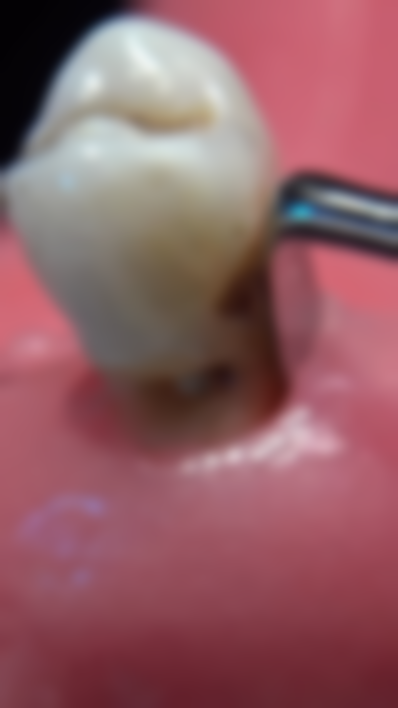 补牙和根管治疗的治疗方法靠谱吗