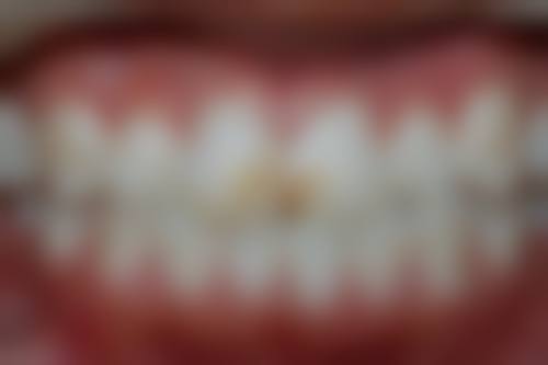 根管治疗多次进行对完全清除感染有什么作用?