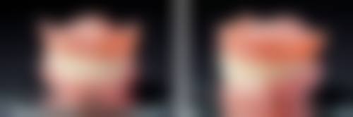 术后护理对做过根管治疗的牙齿寿命有什么影响