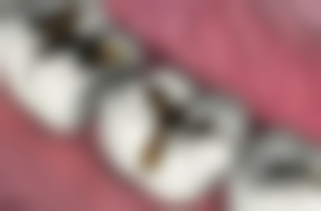 40多岁做牙齿矫正改善美观成效怎么样？