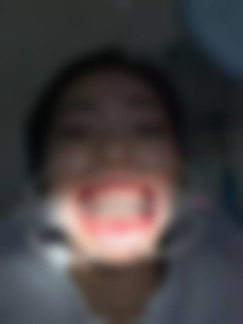 荆州洪湖欧乐口腔真实实例：见证牙齿的蜕变