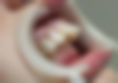 换牙期间矫正地包天适合所有孩子吗