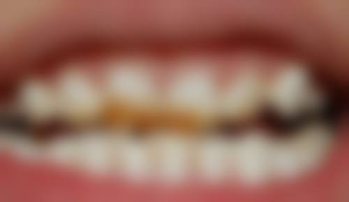 1200一颗的全瓷牙质量怎么样