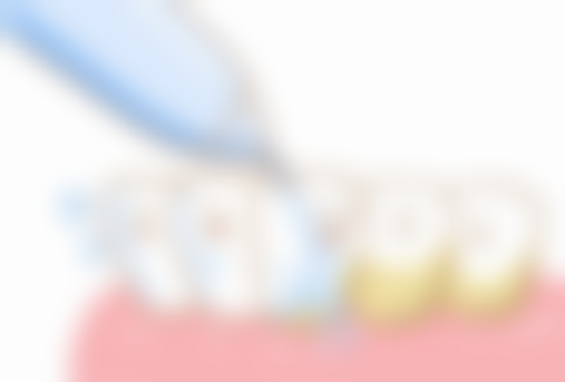 1200一颗的全瓷牙有哪些优势