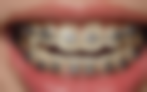 补牙嵌体材质的耐用性如何