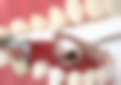 洗牙前询问医生有必要吗？