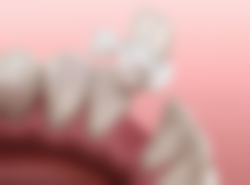 不同手术方式对拔牙种牙时间有什么改变