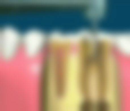 牙齿错位地包天矫正值不值