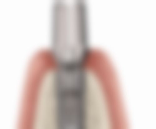 青少年根管治疗后用药管理的依据是什么