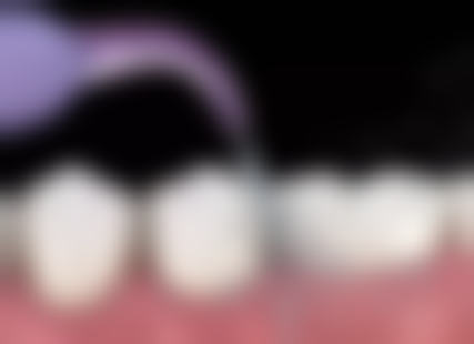 上午拔牙能降低出血风险是真的吗