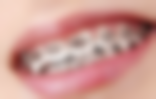 手术辅助矫正龅牙不用拔牙适合成年人吗