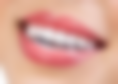 韩国进口种植牙美格真牌子适合哪些人