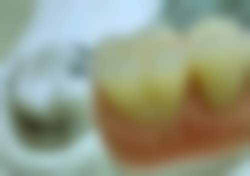 安种植牙植骨有哪些注意事项