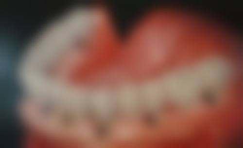 湖南武汉皓丽雅口腔真实实例：见证神奇改变