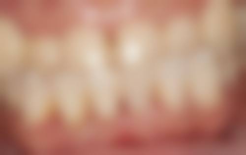 遵义康贝口腔真实实例：看得见的成效，惊艳你的笑容