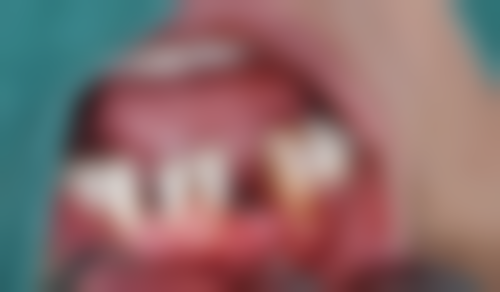 广东东莞常平星超口腔真实实例