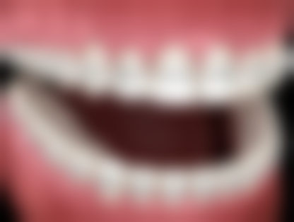 德国威兰德全瓷牙和其他品牌比靠谱吗