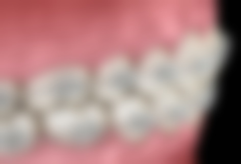 超声波洗牙后刷牙能提升洗牙成效吗