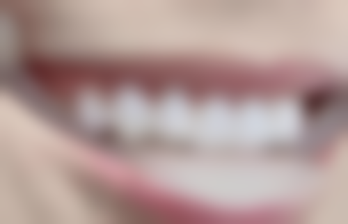 杨传云医生（临沂松果口腔）真实实例超惊艳