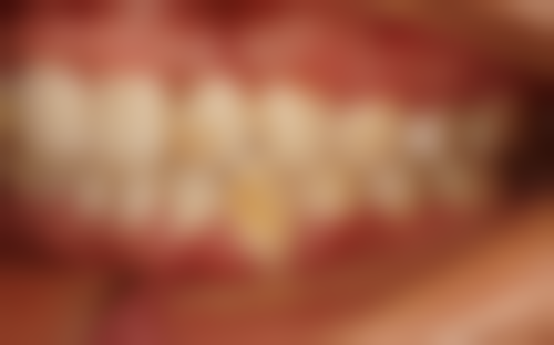 经常去牙科洗牙能拥有清新口气吗