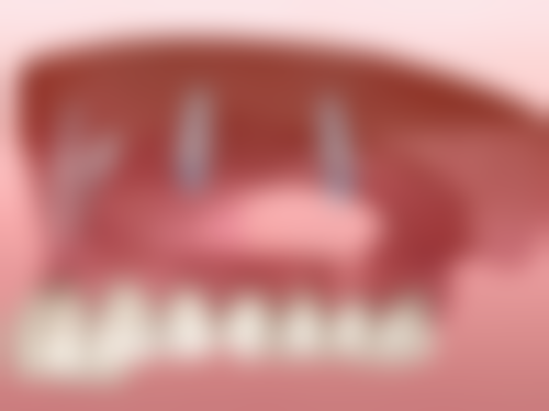 超声波洗牙后24小时内饮食有哪些禁忌