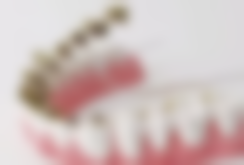 如何根据预算选择国产全瓷牙品牌？