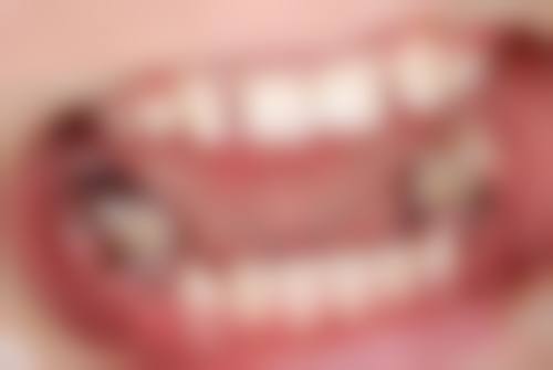 玻璃离子和树脂材料在儿童补牙中的耐磨性哪个好